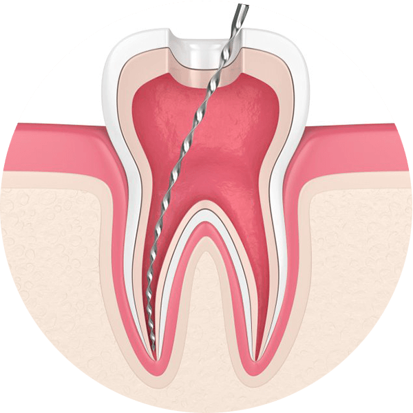 Root Canal Treatment